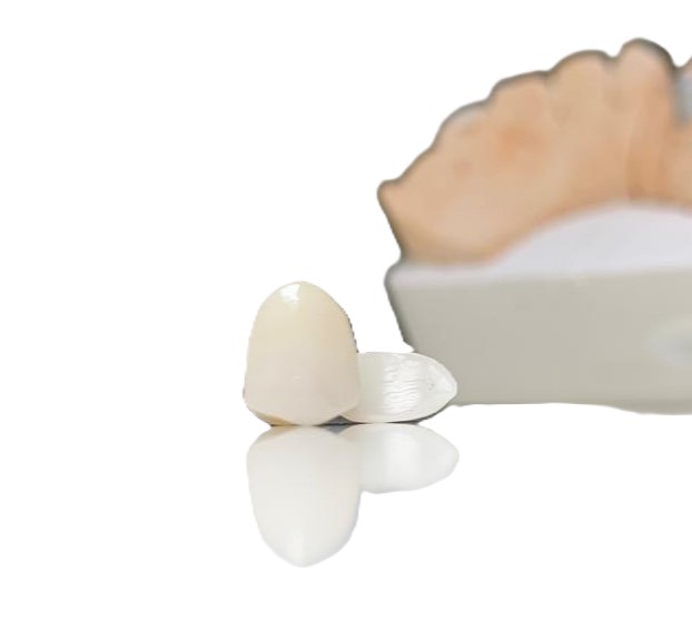 full ceramic mariland bridge