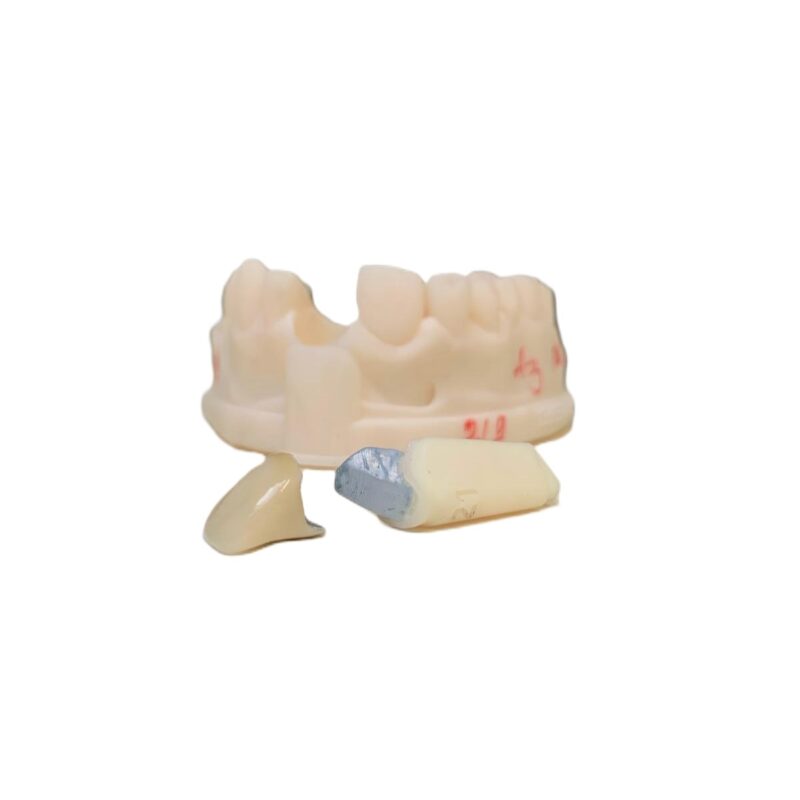 Noritake Super Porcelane bonded crown