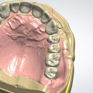 denture cad 3shape