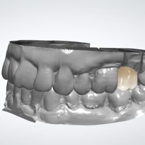 CAD Crowns