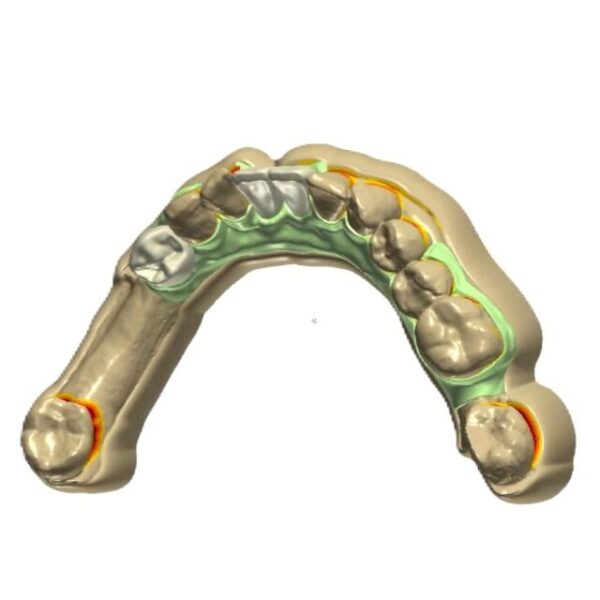 removable partial denture cad