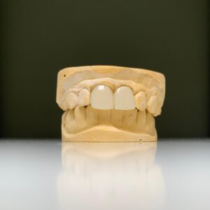 eMax Crowns