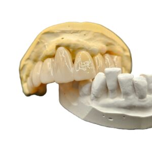 Dental Lab Zirconia Fitted Bridge