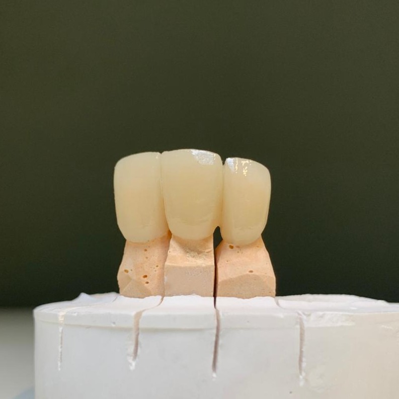 dental lab emax bridge