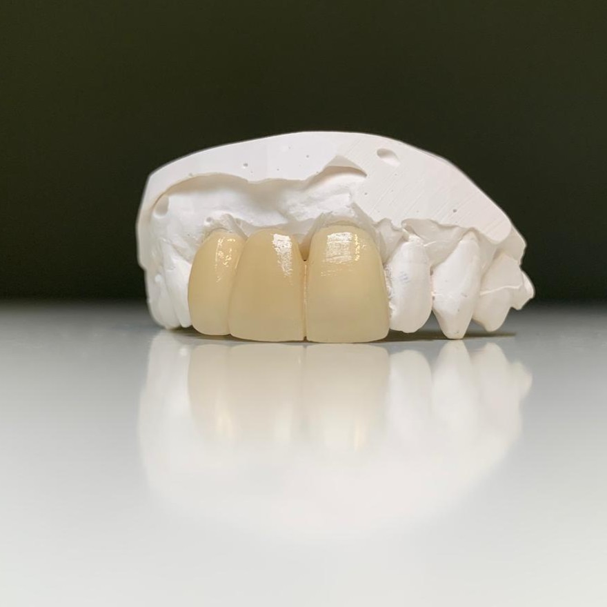 dental lab ips emax cad bridge