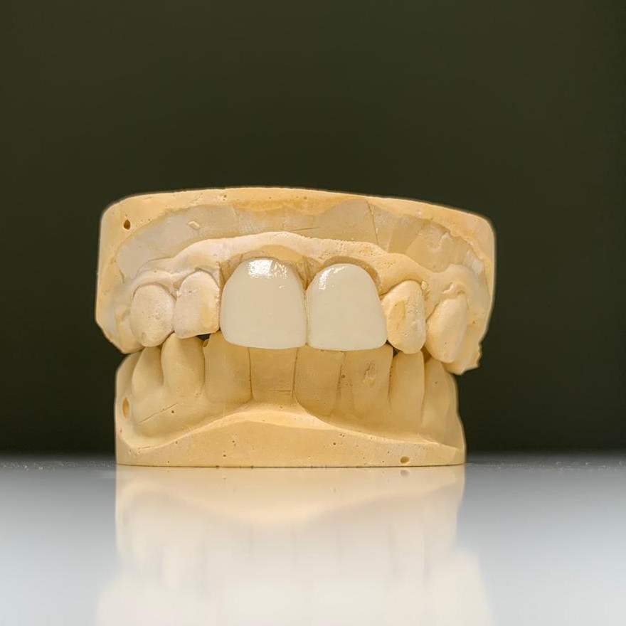 Dental Lab emax central bridge