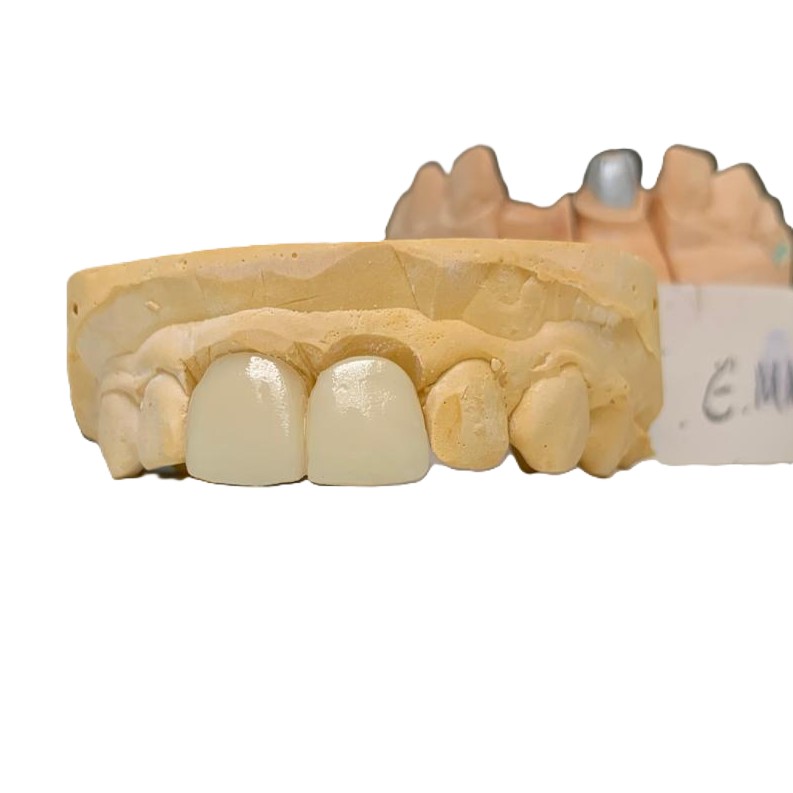 dental lab ips emax cad