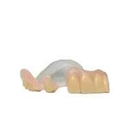 metal free RPD